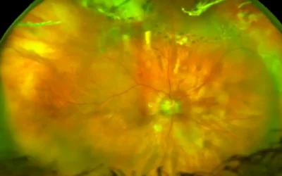 What is MYOPIA Management?