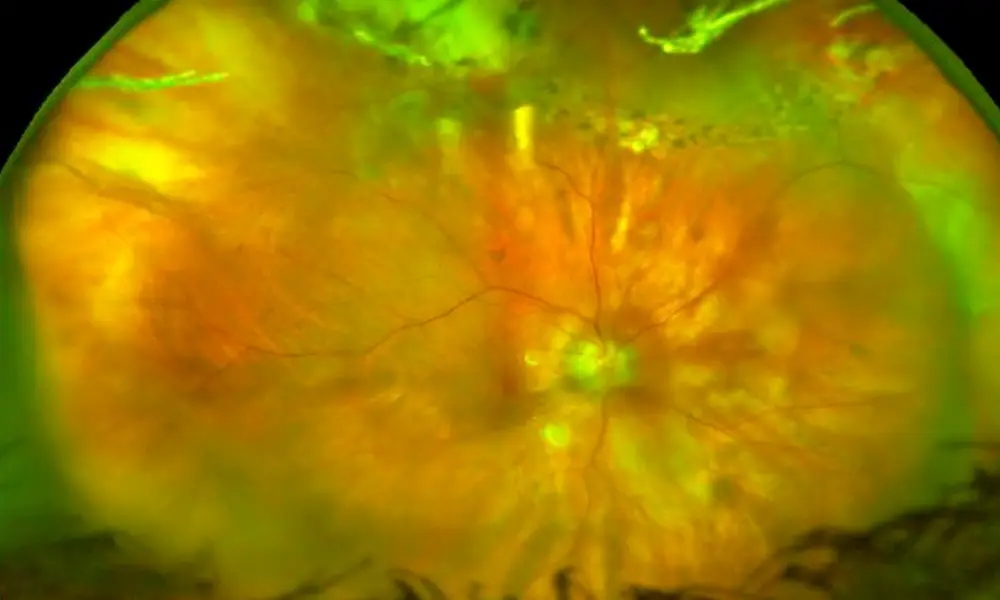 What is MYOPIA Management?